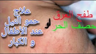 أقوى علاج لحمو النيل او طفح العرق