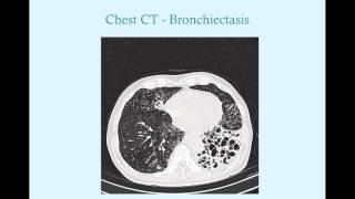 Bronchiectasis - CRASH! Medical Review Series