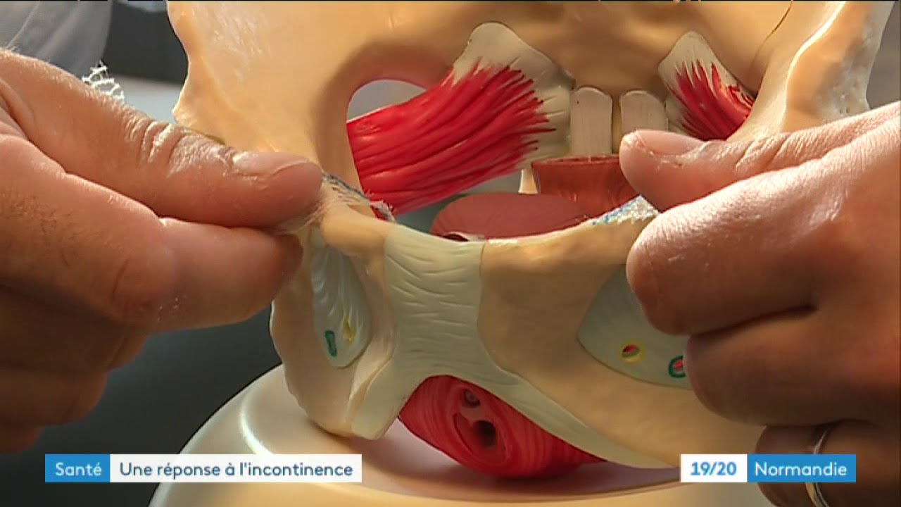 Une opération contre l'incontinence précoce chez les femmes