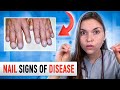 Doctor Explains what your NAILS say about your HEALTH: Top 10 Nail Problems