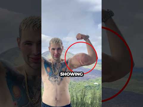 His Hands Might Get Amputated🤯😱(@bazookahands)