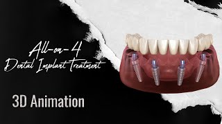 How is All-on-4 Dental Implant Treatment Performed? 3D Animation