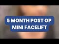 5 MONTH POST OP MINI FACELIFT