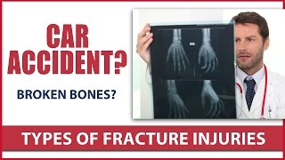 Auto Accident Attorney Fractures after an accident
