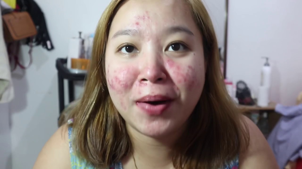 acne-progress-now-using-diane-pills-and-beautederm-youtube