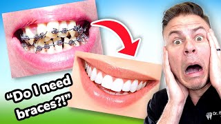 How To Tell If You Need BRACES! The ULTIMATE Braces Guide Ep. 1 Resimi