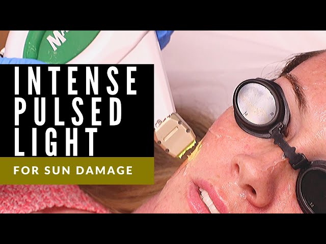Intense Pulsed Light (IPL) for Sun Damage | Pigmentation and Sun Spots | Dr. Thomas E. Young