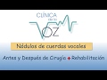 Nodulos de cuerdas vocales antes y despues de cirugia