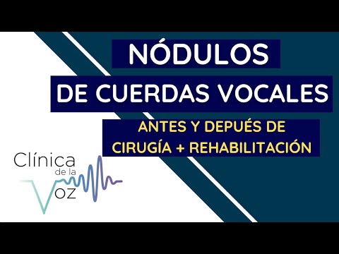 Nodulos de cuerdas vocales antes y despues de cirugia