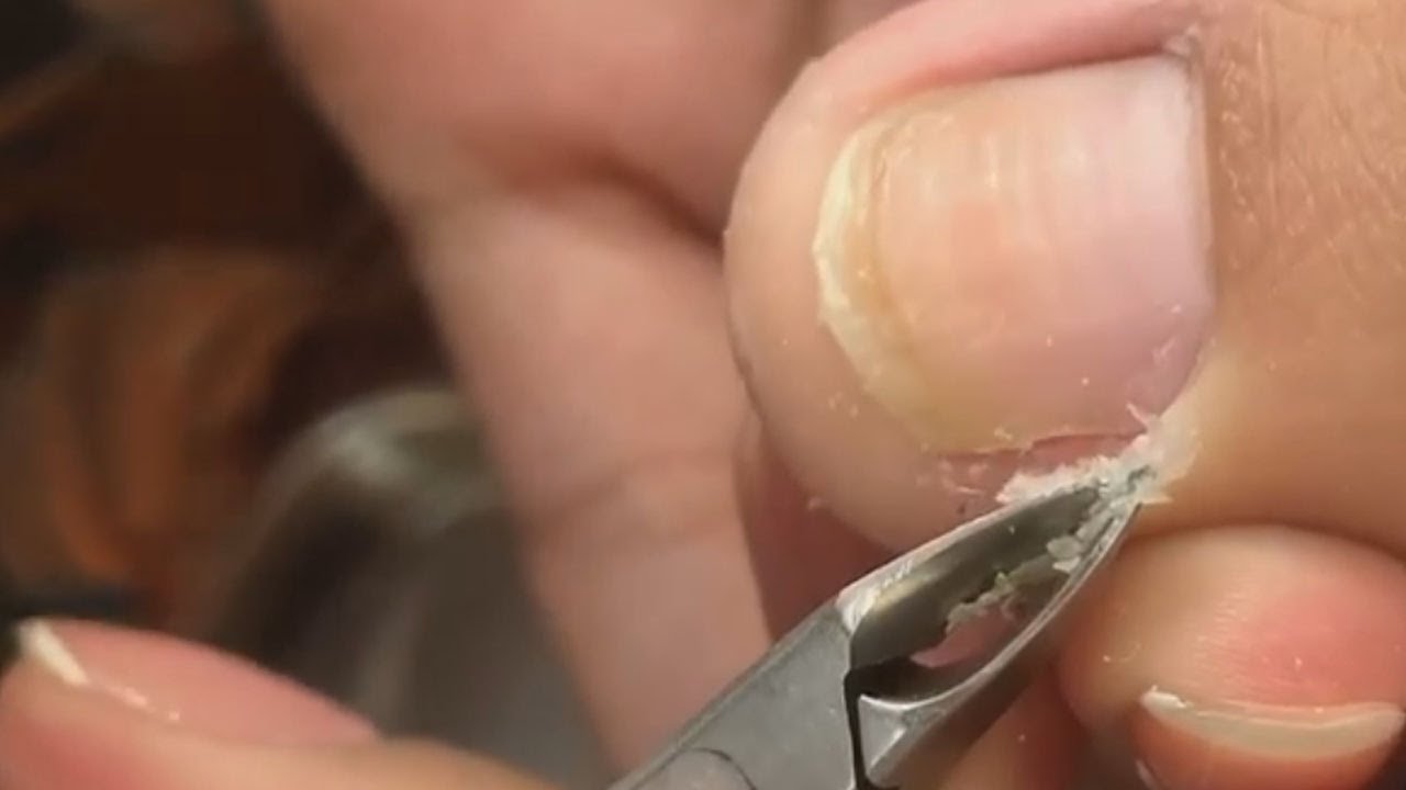 HOW TO CUT THICK TOENAILS Toenail Cleaning Satisfying 292 YouTube