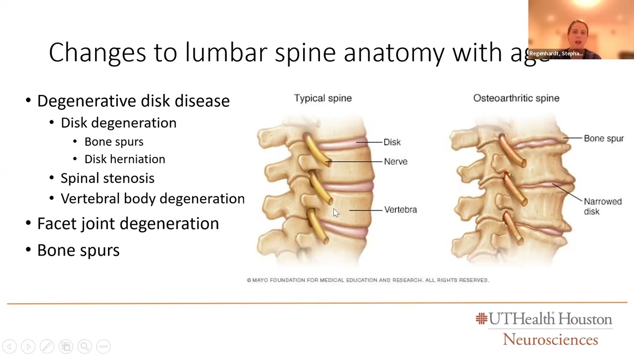 bpc 157 for herniated disc The Future of Spinal Fusion: How New Technologies Are Changing the Game main image 1