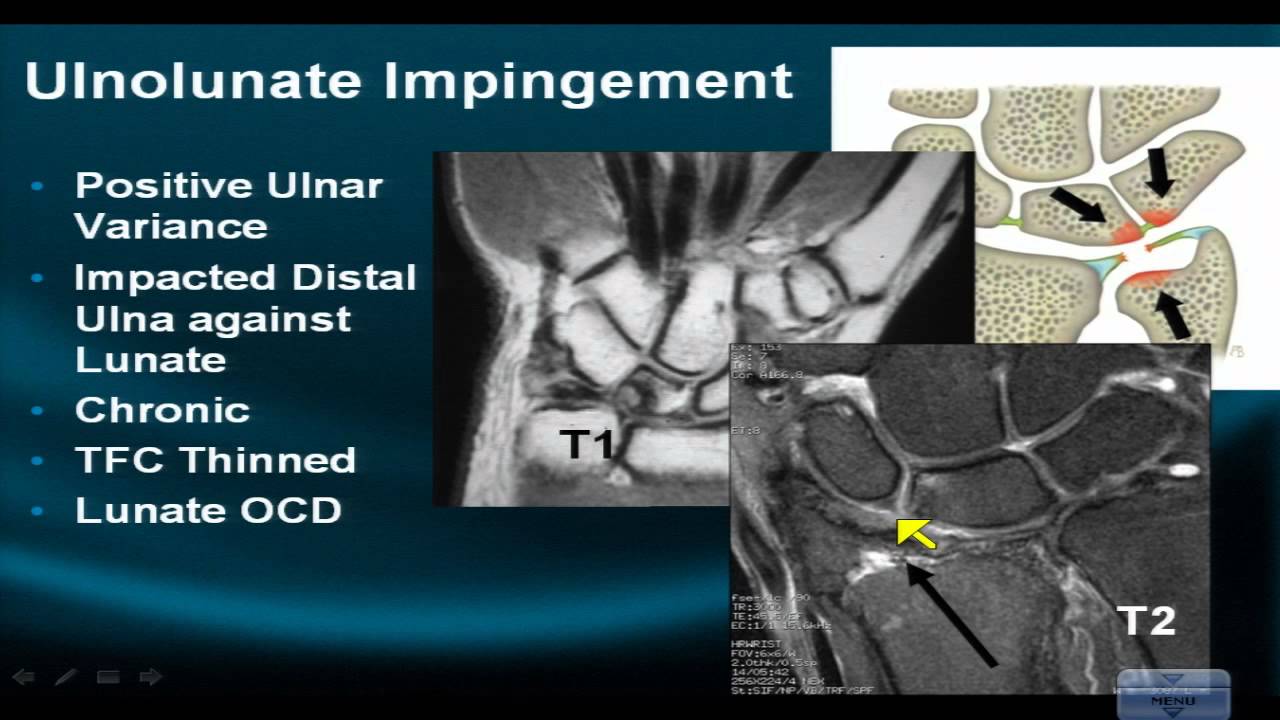 MRI Online Wrist Part VI Evaluating Impingement Syndromes of the Wrist