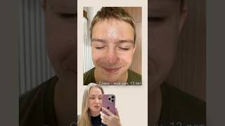 Проблемы с кожей у сына 13 лет, что делать? 