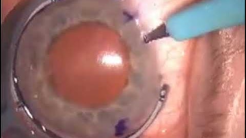 Iris Hooks In a Diamond Configuration