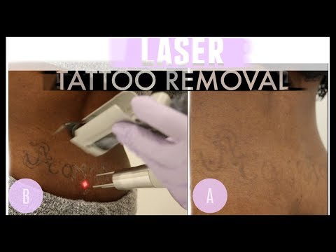 GOODBYE Tramp Stamp! LASER TATTOO REMOVAL on Dark Skin| LaserAway
