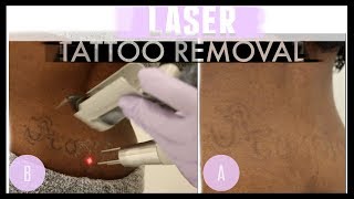 GOODBYE Tramp Stamp! LASER TATTOO REMOVAL on Dark Skin| LaserAway