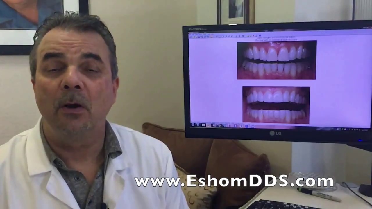 Alternative to porcelain veneers