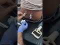Slip disc problem | back pain |  Cuppiy therapy | #cuppingtherapy #slipdisc #hizama