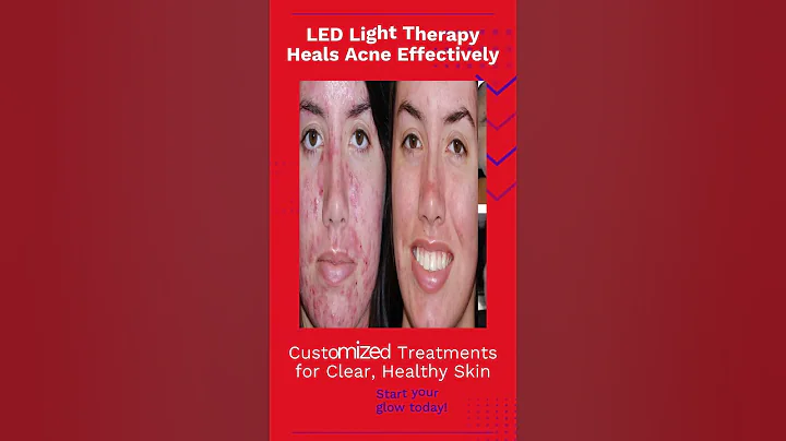 LED Light Therapy Heals Acne Effectively
