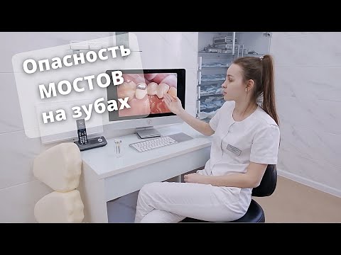 МОСТЫ НА ЗУБЫ | Опасность установки мостовидных протезов. Мнение стоматолога