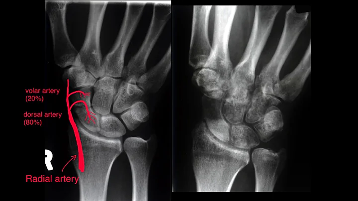 Scaphoid fracture - why knowing your anatomy is so important