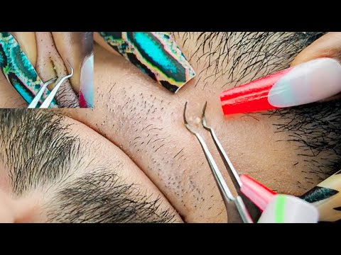 ASMR | Attentive Face Picking Ingrowns With Tweezers.