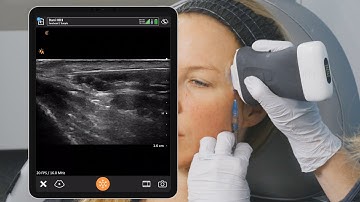 Ultrasound Guided Temple Injection Left Side