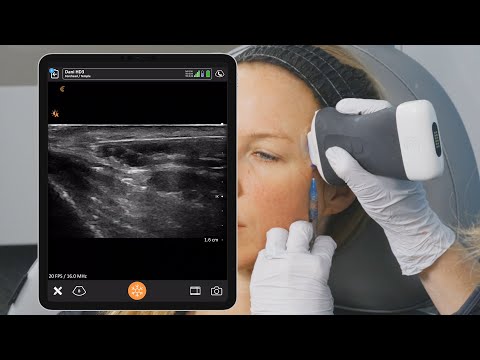 Pocus Foot Injection Ultrasound Guided Temple Injection Left Side – PoCUS FOAMED