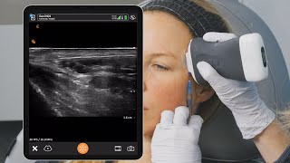 Information Ultrasound Guided Temple Injection Left Side News