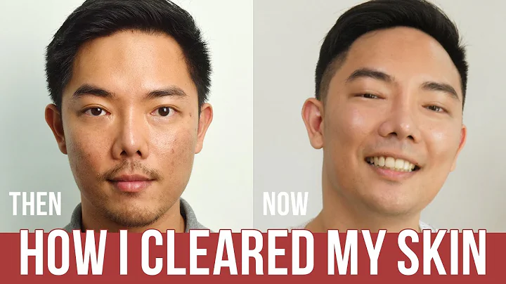 My Acne Story: How I Cleared My Skin | It's Eugene...