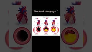heart attack warning ⚠️#nursing # heart health tips#medicoloverzone # youtube shorts # trendy shorts