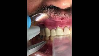 Bite registration using leaf gauges at a new vertical dimension