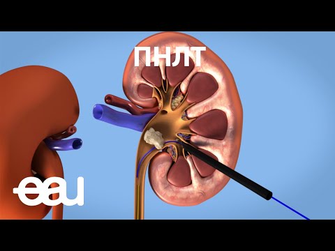 Перкутанная нефролитотомия - ПНЛТ (EAU - PCNL RU)