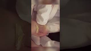 caving toenails removal ingrown nail