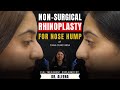 15 min nonsurgical rhinoplasty in mumbai case study by draleena cara clinic mumbai 