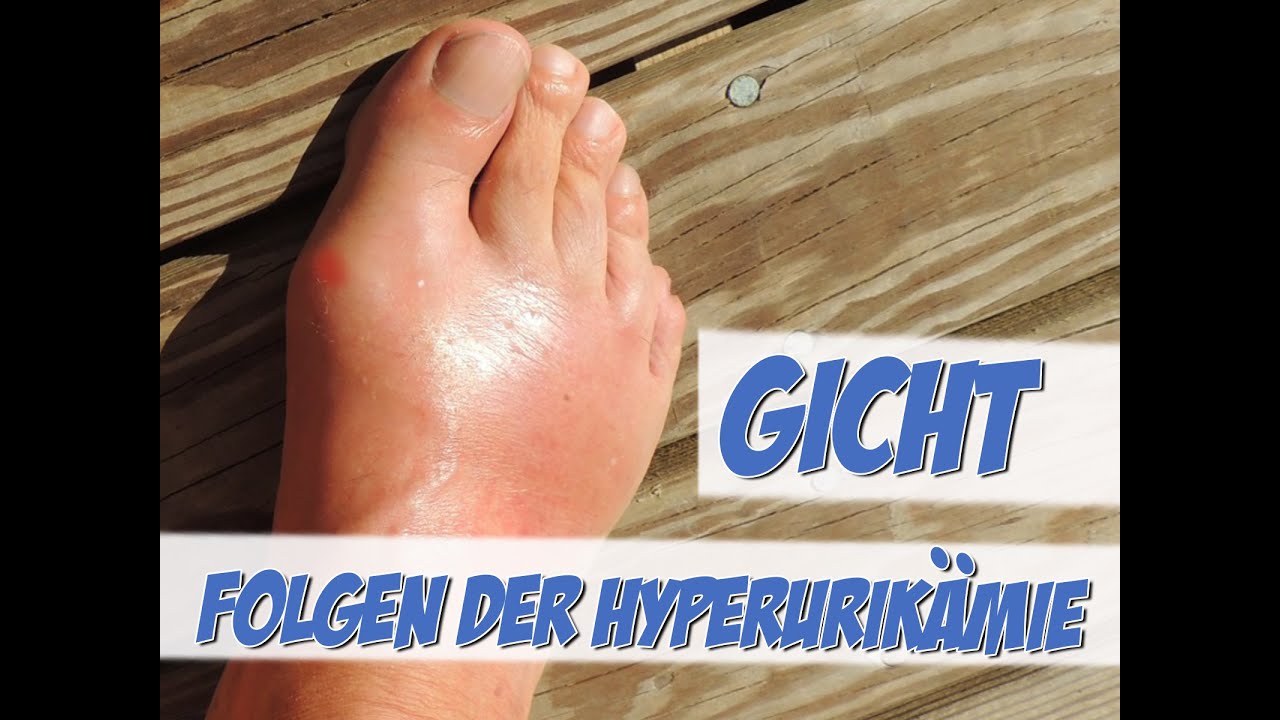 Gicht: Folgen der Hyperurikämie - YouTube
