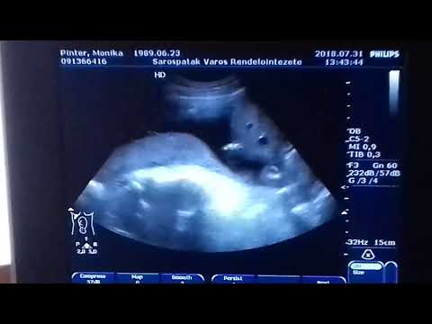 Videó: 23 Hetes Terhes - Mi Folyik Itt? Magzati Fejlődés, érzések, Ultrahang