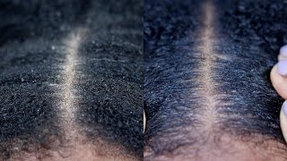 How To Stop DRY/FLAKY Scalp On Coarse Type 4C Hair