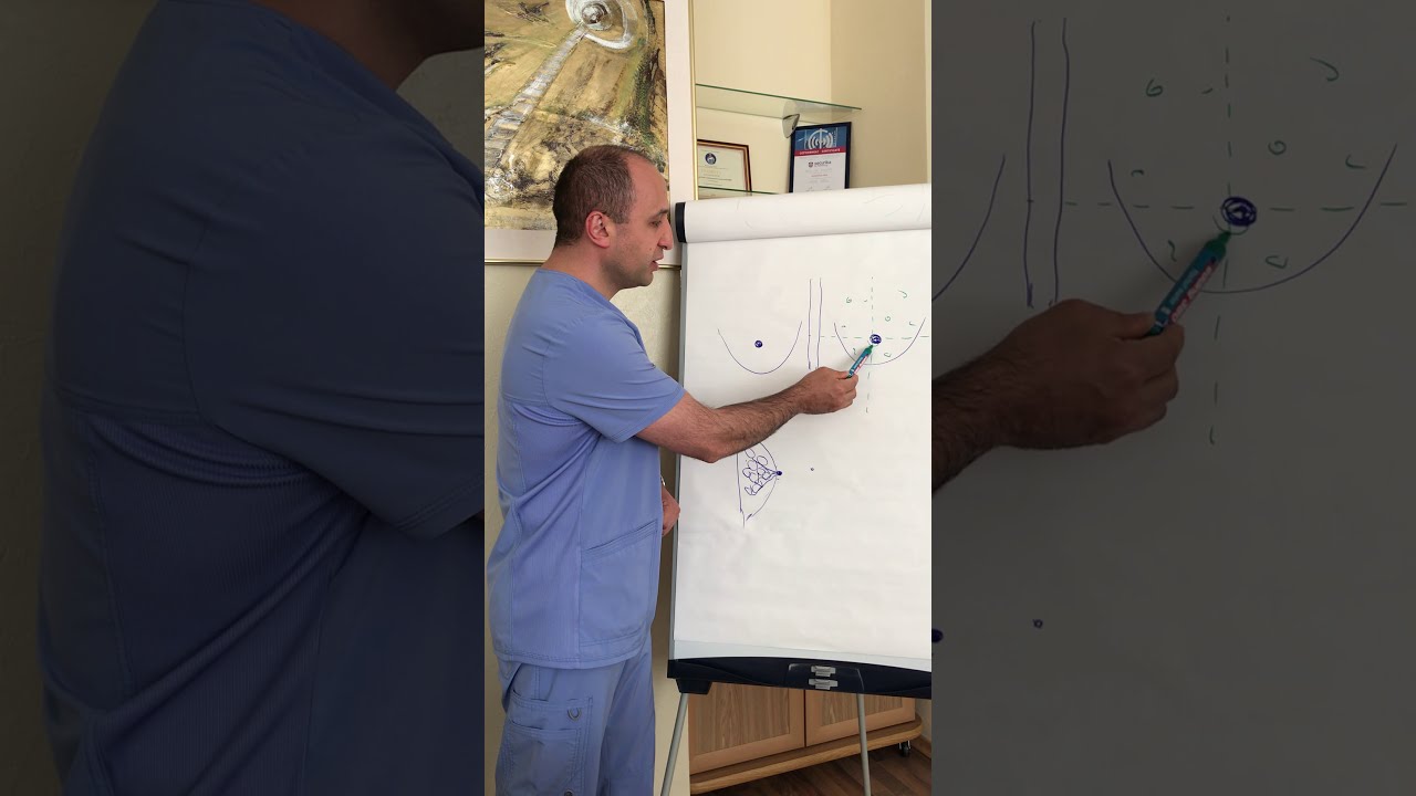 КАКОЙ ДОСТУП ПРИ МАММОПЛАСТИКЕ ЛУЧШИЙ? Доктор Карапетян