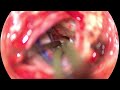 Trigeminal schwannoma excision with neuromonitoring 1080p