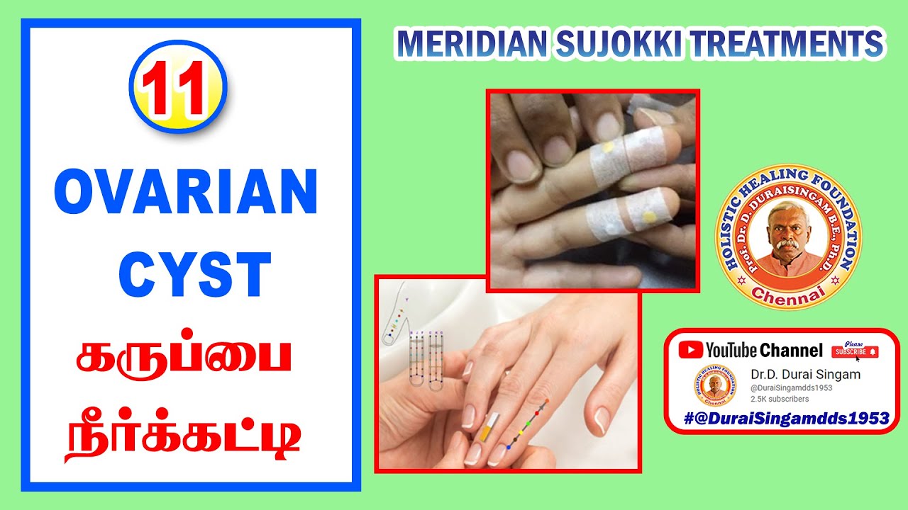 11.Ovarian Cyst கருப்பை நீர் கட்டிMERIDIAN SUJOKKI TREATMENT by Prof