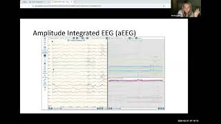 Quantitative EEG Analysis