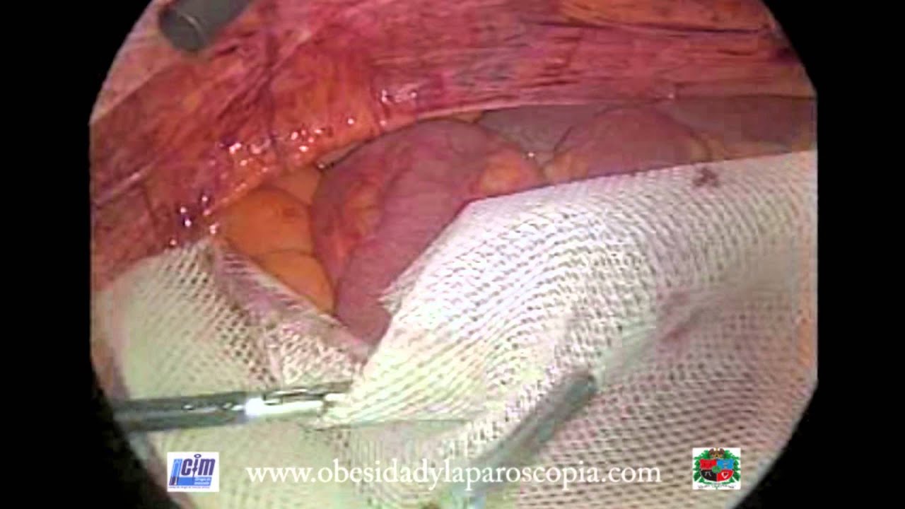 abdominal con malla por laparoscopia YouTube