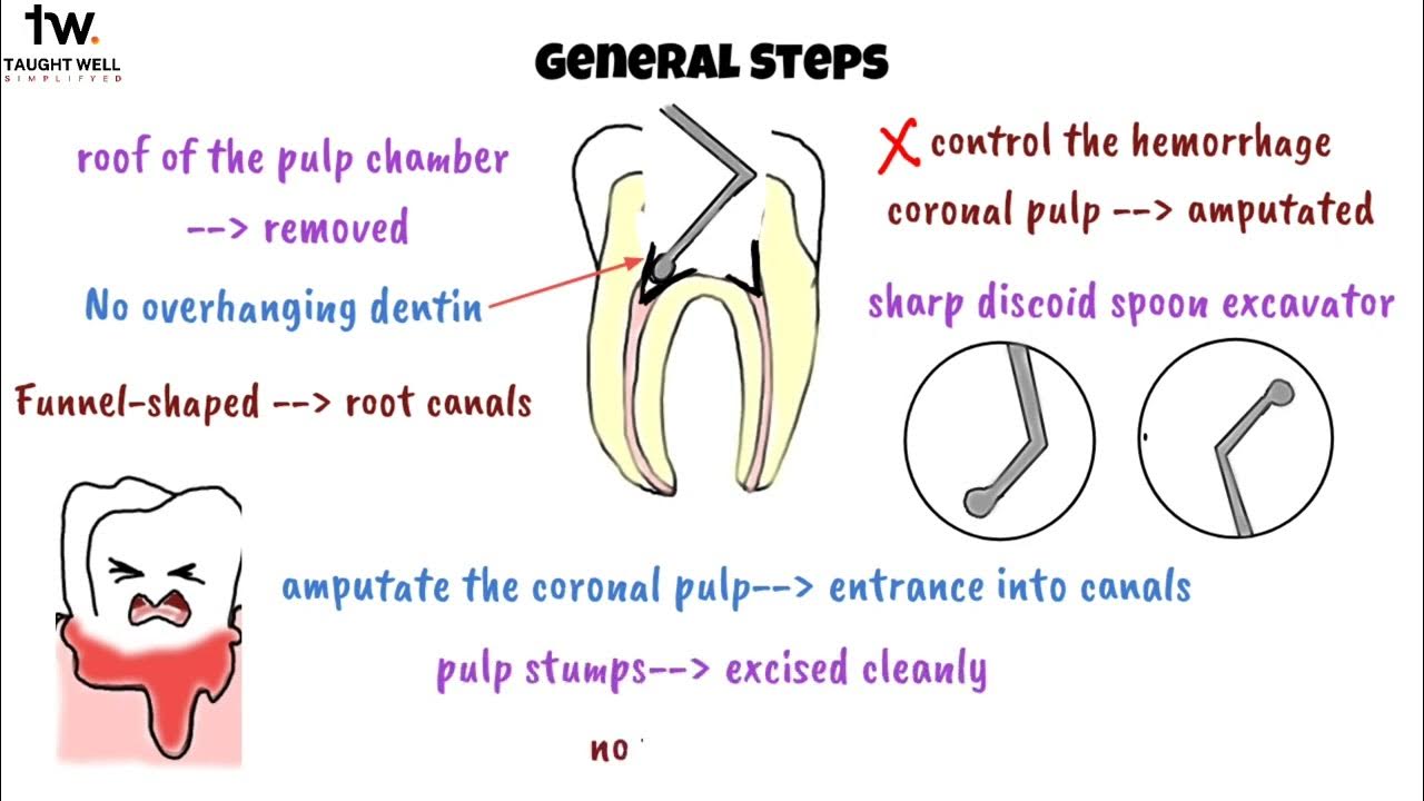 Pulpotomy 101 The Ultimate Guide for Dental Students Master the