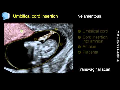 Video: Wat betekent het inbrengen van velamenteuze navelstreng?
