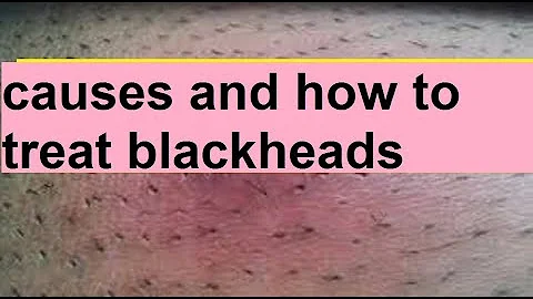 Causes and how to remove blackheads