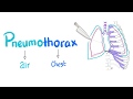 Pneumothorax | Lung Physiology | Pulmonary Medicine