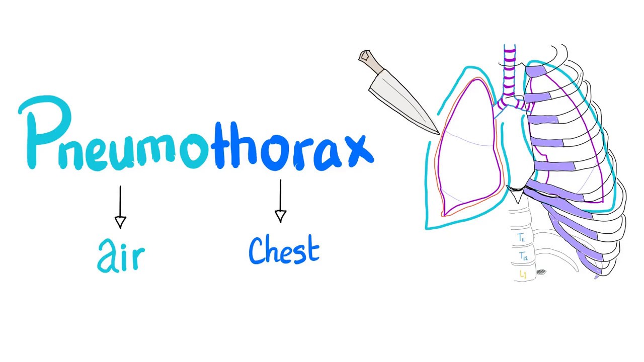 Pneumothorax Diagram