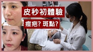 這麼神 PICOCARE 皮秒雷射一個月紀錄+心得 l 咪塔Mita