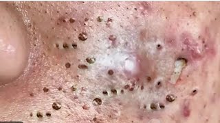 ??????? ????????? ??????? ?? ???? ???? ???? 80000        NASA  blackheads blackheadswhiteheads